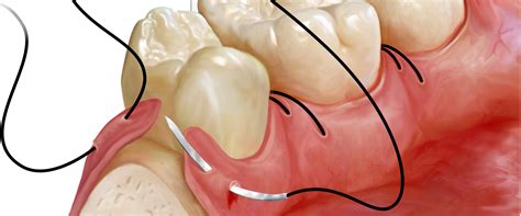 Osseous Surgery North Suburban Periodonticsnorth Suburban Periodontics