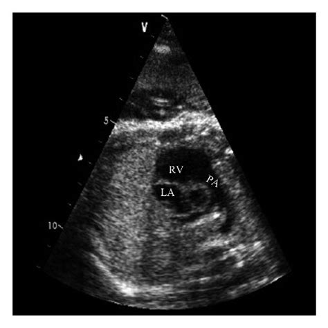 Tetralogy of Fallot (TOF) (28 w). (a) The right ventricular outflow ...