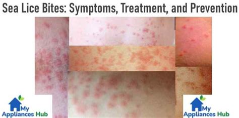 Sea Lice Bites Symptoms Treatment And Prevention