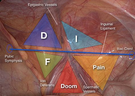 PDF SYSTEMIZATION OF LAPAROSCOPIC INGUINAL HERNIA REPAIR TAPP BASED