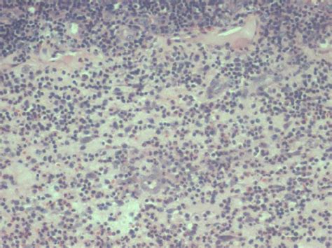 Higher View Of The Acute Inflammatory Exudate Comprising Neutrophils