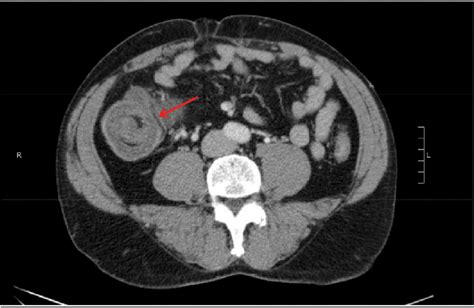 Axial Ct Of Abdomen Pelvis Appendiceal Colonic Intussusception With