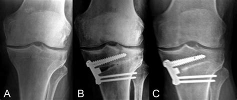 Knee Deformities Josué Calderón Gamba Md