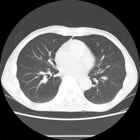 Figure Chest Computed Tomography Ct Obtained During The Patient S