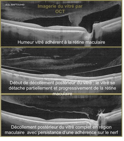 Pathologies Oculaires Centre Ophtalmologique Rabelais