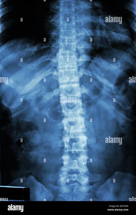 X Ray Normal Lumbar Spine Hi Res Stock Photography And Images Alamy