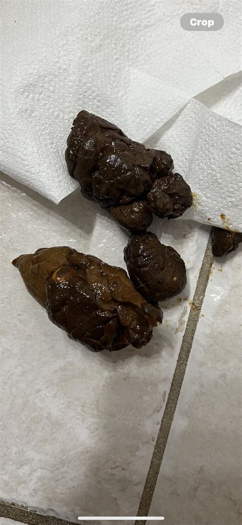 Does This Look Like Black Stool Rpoop