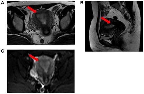 Mri Findings A Axial T2 Weighted Image T2w1 B Sagittal Download Scientific Diagram