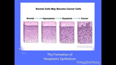 Metaplasia Heteroplasia Dysplasia Neoplasia Hyperplasia And Anaplasia Youtube