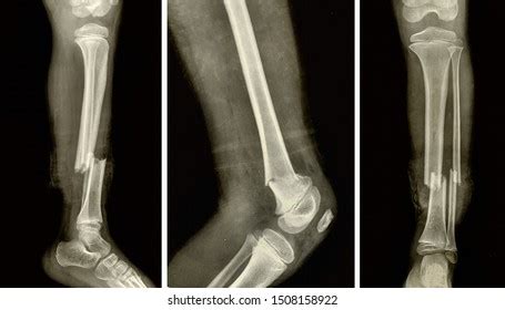 Hip Femur Fracture X Ray Stock Photo 1508158922 | Shutterstock