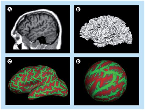 Surface Based Morphometry Processing Steps A High Resolution