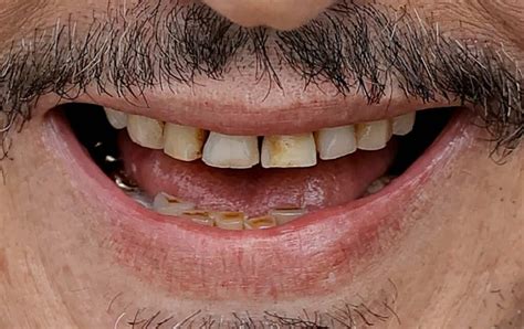 Whats The Story Of Johnny Depp New Teeth Captain Jack Sparrow S Teeth