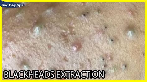 Big Cystic Acne Blackheads Extraction Blackheads And Milia Sac Dep Spa