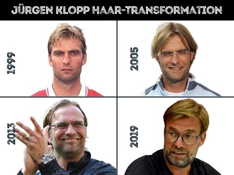 Jürgen Klopp Haartransplantation Haarausfall Technische Analyse