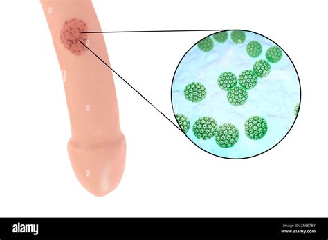 Verrugas Del Pene Genitales Y Vista De Cerca Del Virus Del Papiloma