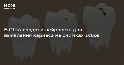 В США создали нейросеть для выявления кариеса на снимках зубов — Нож