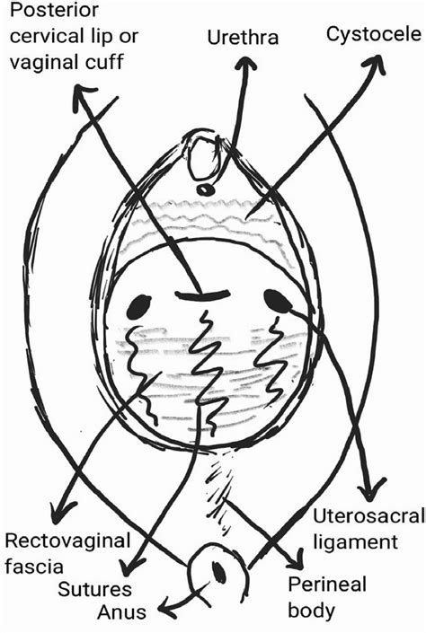 Diagram Of Sutures From Rectovaginal Fascia To The Pericervical Ring