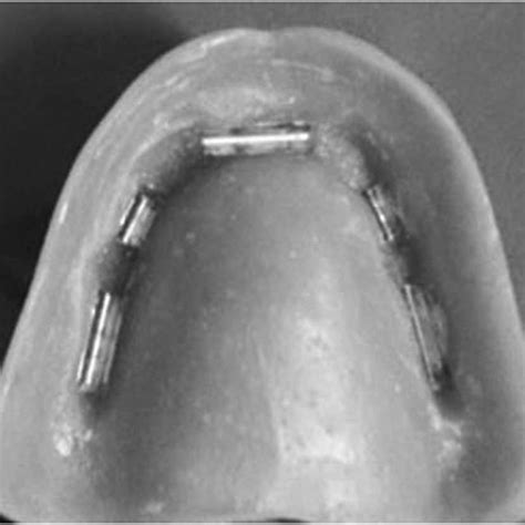 Locator retained maxillary overdenture. (A) Locator abutments screwed ...