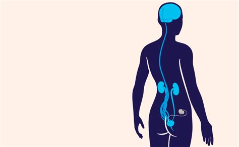 Cost Of Interstim Therapy How To Control Bladder And Bowel In Chennai