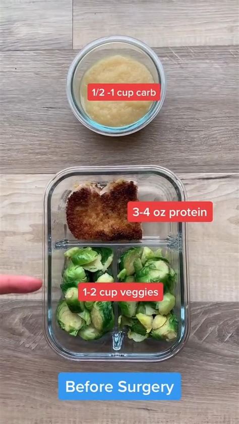 Portion Control Before And After Bariatric Surgery An Immersive Guide