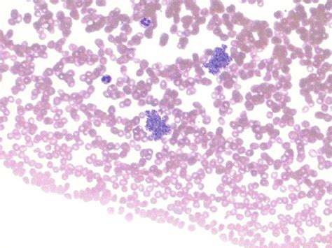 High power view of stained EDTA-blood peripheral smear demonstrating ...