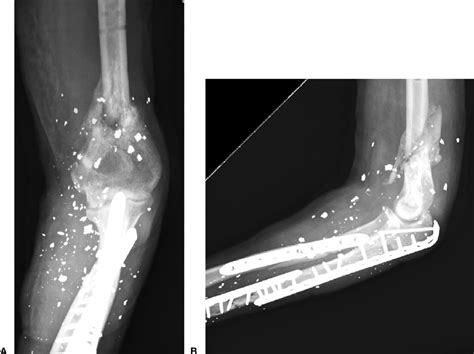 Postoperative A Anteroposterior And B Lateral Radiographs Demonstrating