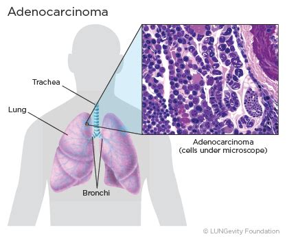 En segundo lugar Partido Colaborar con lung cancer medical term Conciso Ahuyentar moneda