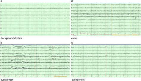 Surface Eeg Recordings From Prolonged Video Electroencephalography Download Scientific Diagram