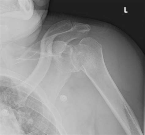 A Ap Radiograph Of The Left Shoulder Demonstrating A Comminuted Proximal Download Scientific