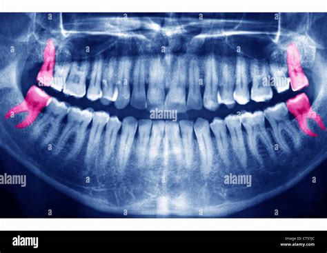 Wisdom teeth x ray hi-res stock photography and images - Alamy