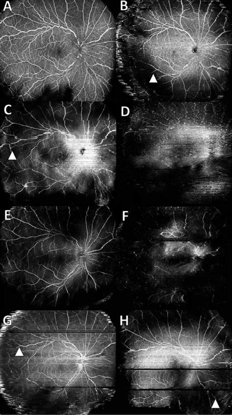 En Face Ultra Widefield Optical Coherence Tomography Angiography OCTA