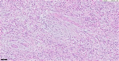 Pathology Outlines Inflammatory Fibroid Polyp