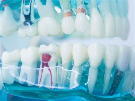 Endodoncia Cómo saber si necesitas un tratamiento de conducto