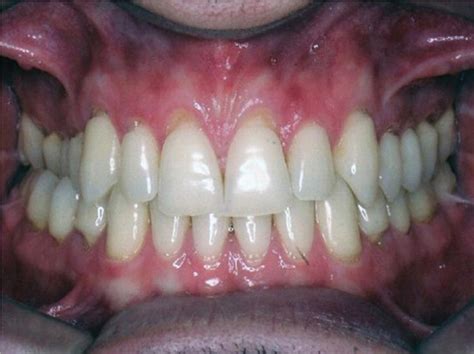 Pretreatment Intraoral And Maxillary Dental Cast Photographs