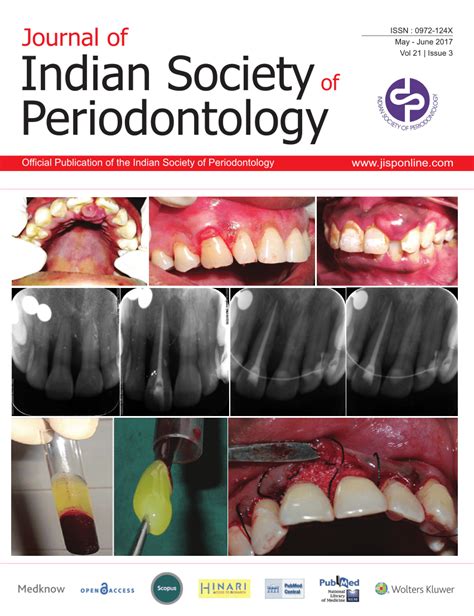 PDF Root Coverage Of A Wide Anterior Mucogingival Defect With