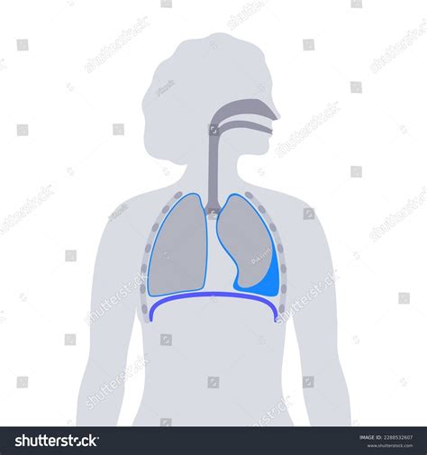 Pleural Effusion Disease Fluid Between Layers Stock Vector Royalty