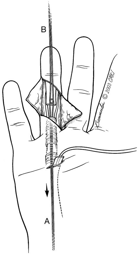 A Simple Tendon Retrieval Method F C IWUAGWU A GUPTA 2004