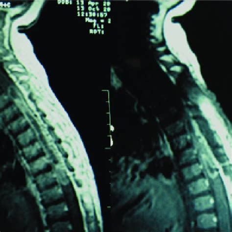 Preoperative Spinal Cord Magnetic Resonance Imaging Shows An Expansive