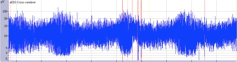 How To Use Amplitude Integrated Eeg Aeeg Adc Education And Practice