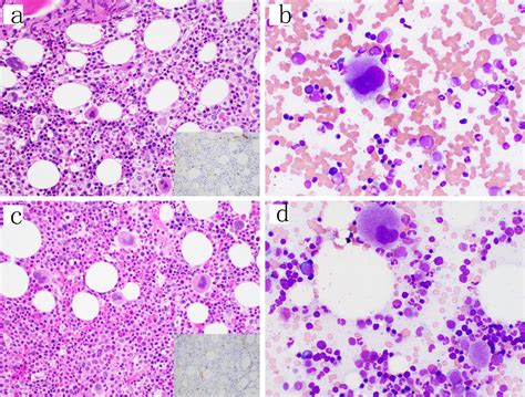 Bone Marrow Core Biopsy