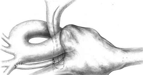 Pulmonary Artery Reconstruction During The Fontan Operation