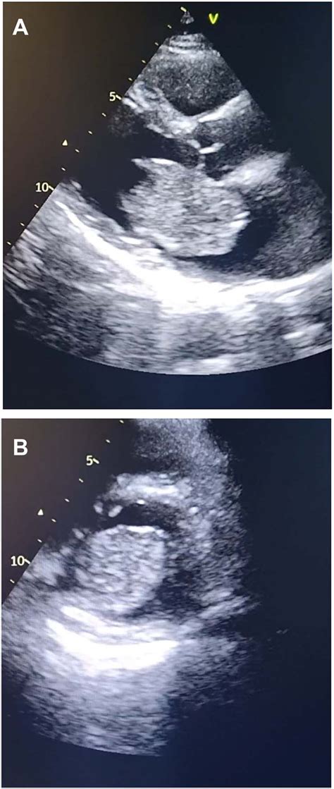 Transthoracic Echocardiography A Echocardiogram Parasternal