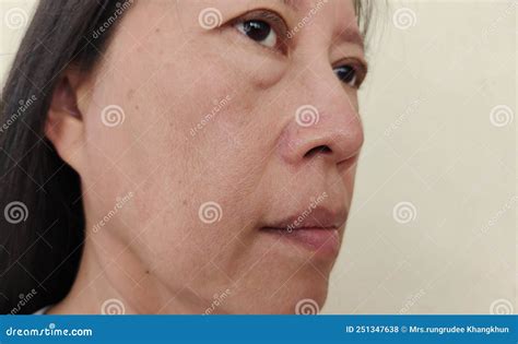 Las Pecas Y Arrugas En La Cara De La Mujer Foto De Archivo Imagen De