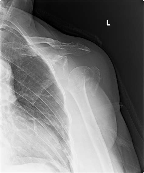 Humerus fracture before | Dr. John Skedros