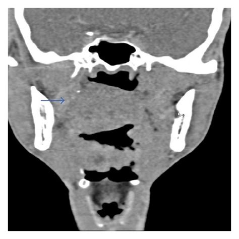 Contrast Enhanced Ct Soft Tissue Window A Sagittal Section B Axial