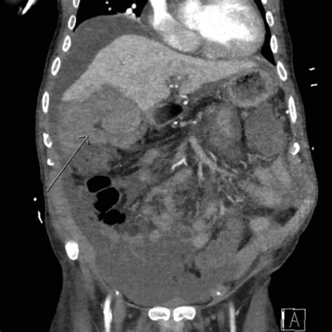 Abdominal And Thoracic Computed Tomography Angiogram Obtained After