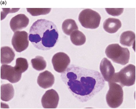 Chapter 11 Myelodysplasticmyeloproliferative Neoplasms Oncohema Key