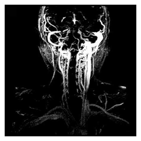 Sagittal View Of Collateral System Dynamic Magnetic Resonance Image