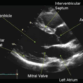 Standard parasternal long axis view with colour fl ow Doppler ...