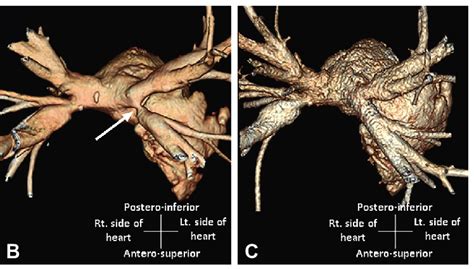 Electroanatomical Map And CT Images A 3D CT Merged NavX